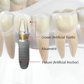 Зубные импланты. Этап протезирования